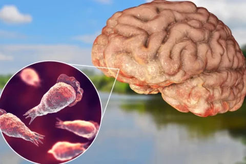 Brain-Eating Amoeba (Amoebic Meningoencephalitis)