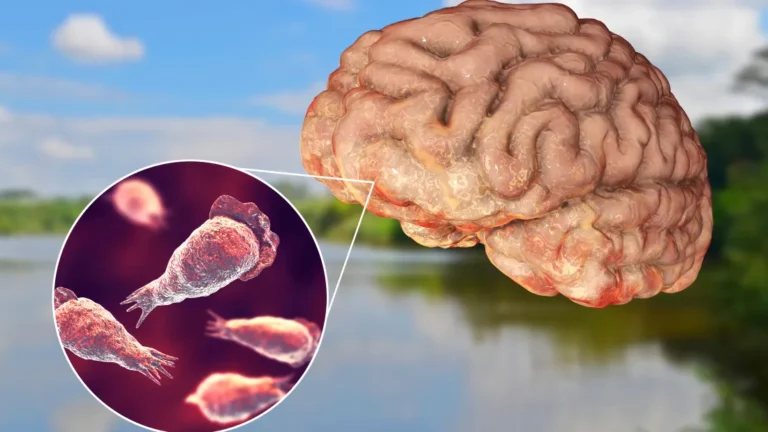 Brain-Eating Amoeba (Amoebic Meningoencephalitis)